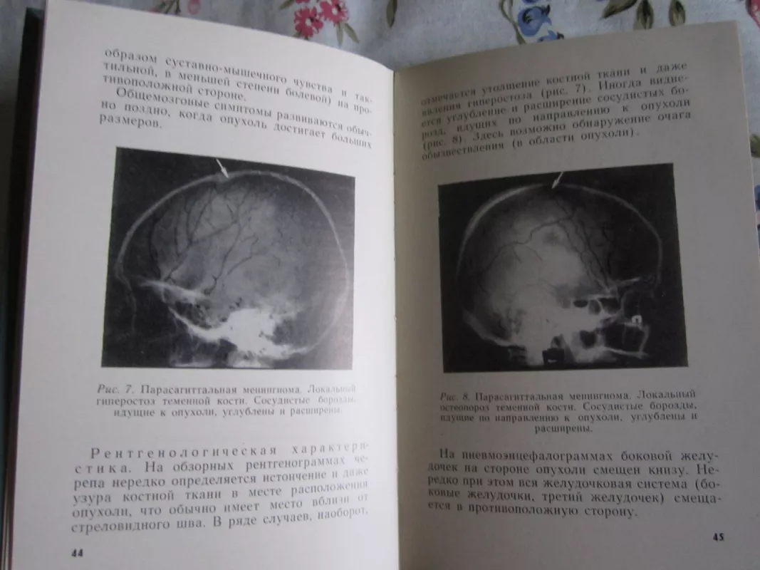 Rentgenologičeskije izmenenija kostei čerepa pri novoobrazovanijach - N. S. Misiuk, knyga 4