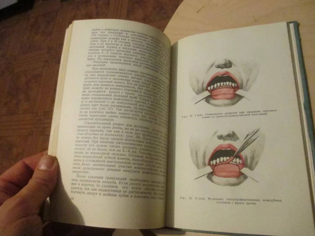 Parodontozė ir jo gydymas panaudojant vakumą - V. I. Kulaženko, knyga 4