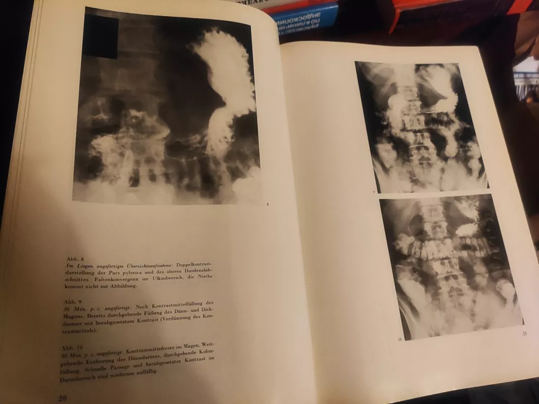 Atlas roentgenologischer Befunde am operierten Magen - Ebehard Baudisch, knyga 6